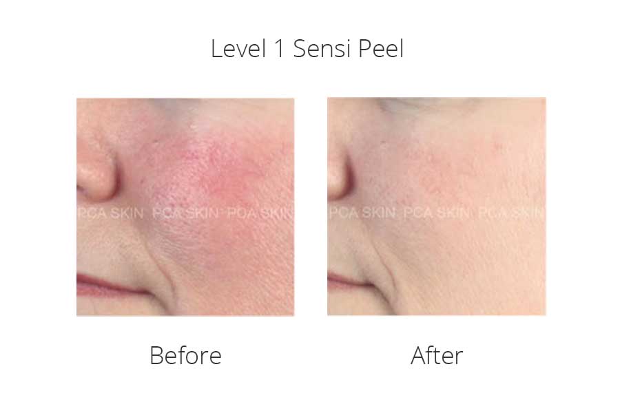 Level 1 Peels La Estetica