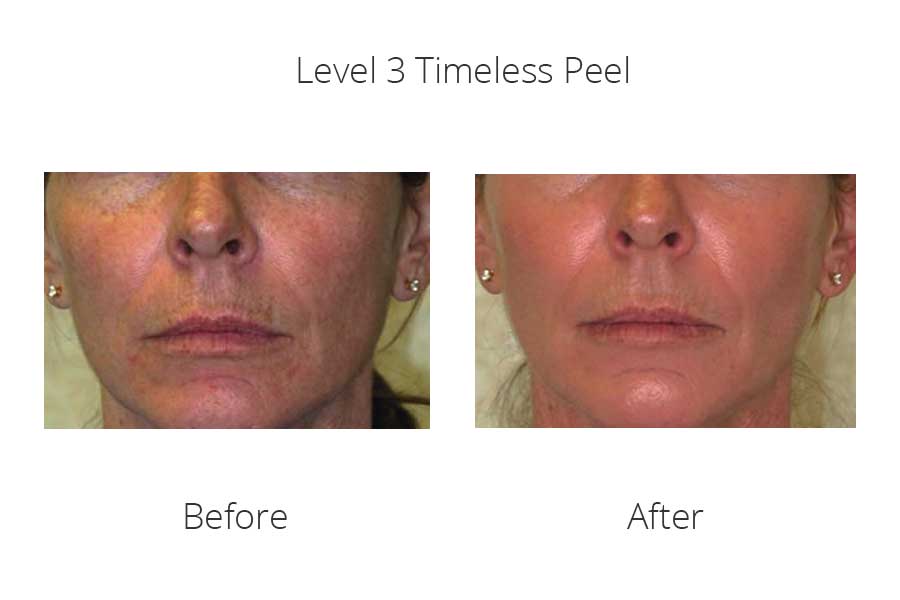 Level 3 Peels La Estetica